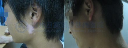 男性耳部局限型白癜风2年